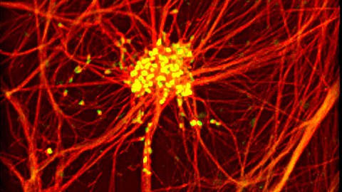 iPS Cells and Neurodegenerative Disease