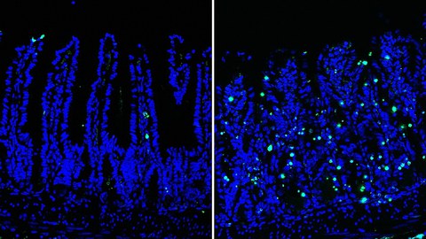 Healthy (right) vs diseased (left) bowel: Extensive DNA damage (green) within the intestinal epithelium leads to inflammatory cell death and disrupts intestinal homeostasis