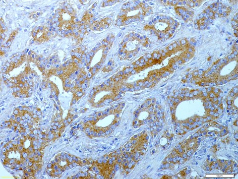 μBONE - Kolonisierung und Interaktionen von Tumorzellen innerhalb der Knochenmikroumgebung