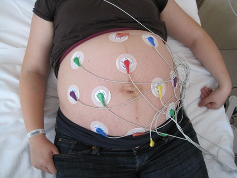 Placement of electrodes on the abdomen to derive the fetal ECG