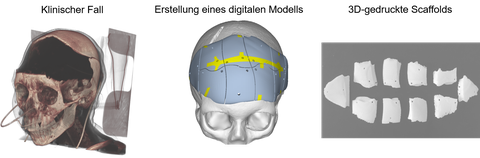 From left to right you can see: A skull with skull defects (missing bone), a digital model of the skull with modeled implants, 3D printed scaffolds (implants)