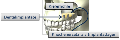 Knochenersatz