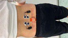 Inertialsensoren und Oberflächenelektromyographiesensoren (OEMG) am Rücken Höhe Lendenwirbelsäule