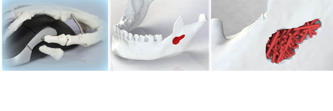 Implantat