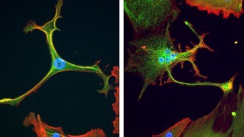 Sarkom cancer cells in culture