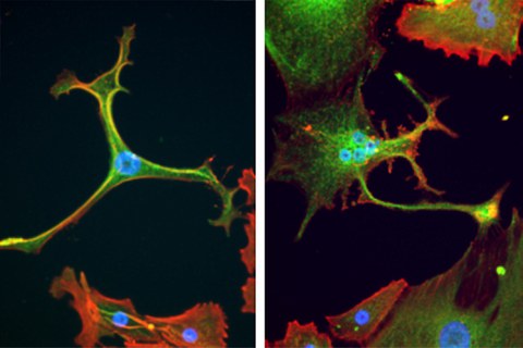 Sarkom cancer cells in culture