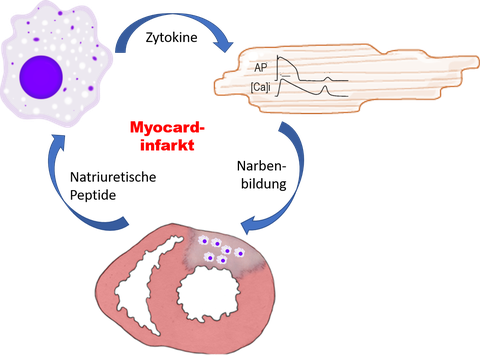 Myocardial Infarction
