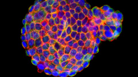 Depicted is a immunofluorescently labeled patient-derived tumor organoid. These cellular models recapitulate the molecular characteristics of a patient’s tumor and can be used to test treatment response.