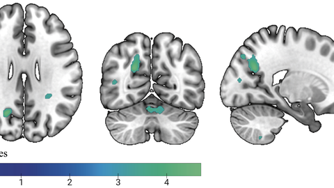 Whole brain activation for the contrast mental state vs. control condition of the RMET 