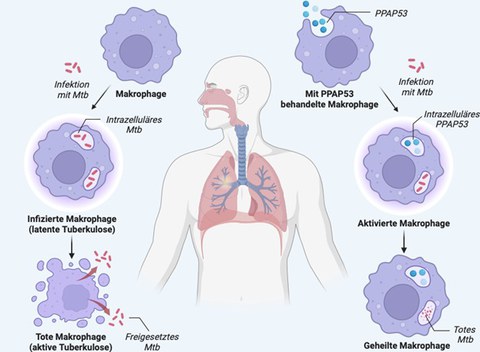 Grafik einer menschlichen Lunge, die den Verlauf einer Tuberkulose-Infektion zeigt.